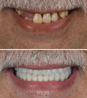 Teeth Turkey Pictures for an all on 6 case rehabilitaion with implants.