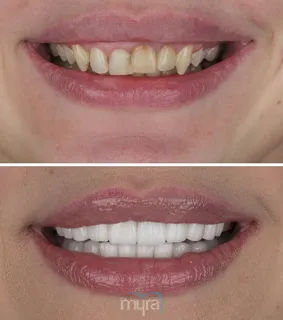 Teeth Turkey Pictures for a deep bite and crooked teeth case with 20 Zirconium Crowns with BL2 colour.