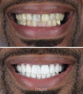 Teeth Turkey Pictures has done with a smile makeover and he got 28 Zirconium Crowns and 6 teeth Implants for missing teeth.