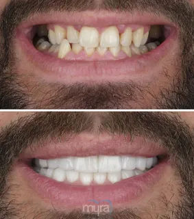 Teeth Turkey Pictures for a narrow smile with cross bite and missing teeth case. He gets a widened smile and correct bite with 27 zirconia crowns.