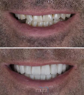 Teeth Turkey Pictures for a dental work who get 6 implants and 26 emax crowns.