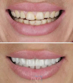 Teeth Turkey Pictures for grinded teeth and composite bonding done case with 20 laminete veneers as BL2 colour.