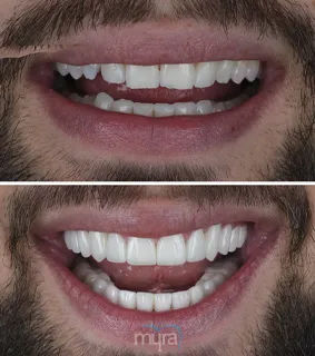 Teeth Turkey Pictures has done with 28 Celtra Crowns as BL2 colour to get an asymetric smile for grinded teeth.