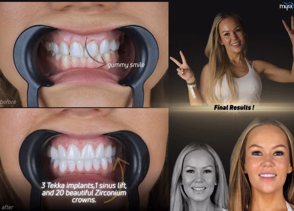 Gummy Smile