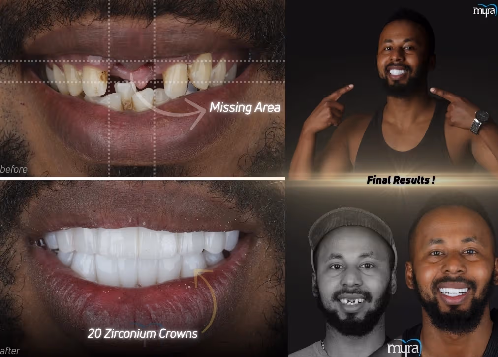 Missing Teeth