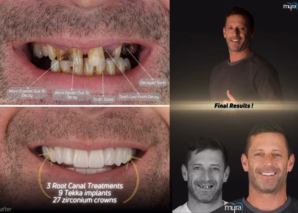 Tooth Decay