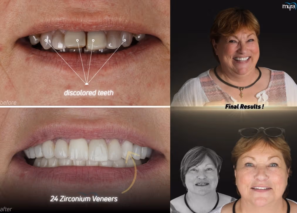 Tooth Discoloration and Staining