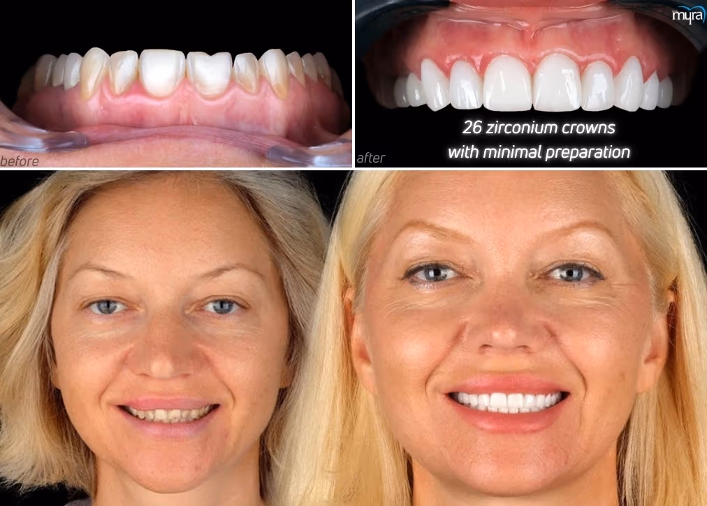 Turkey Teeth Before and After