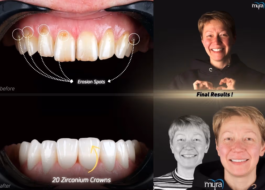 Worn or Eroded Teeth