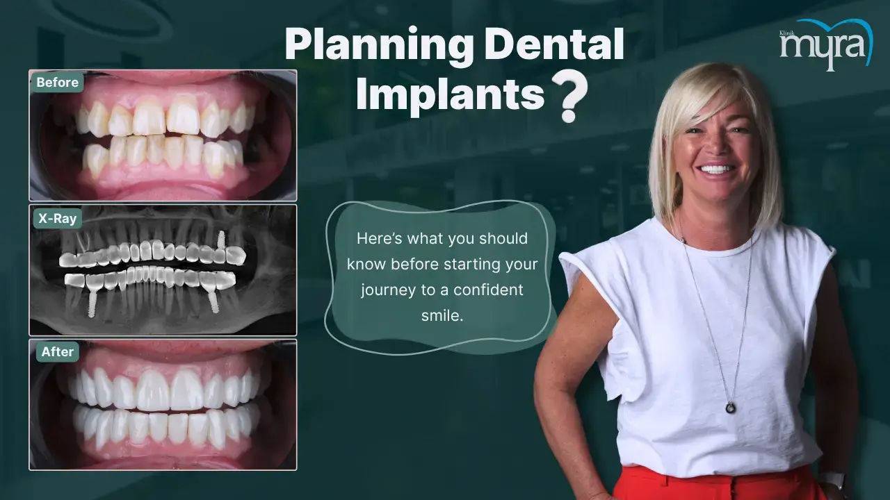 Before Getting Dental Implant