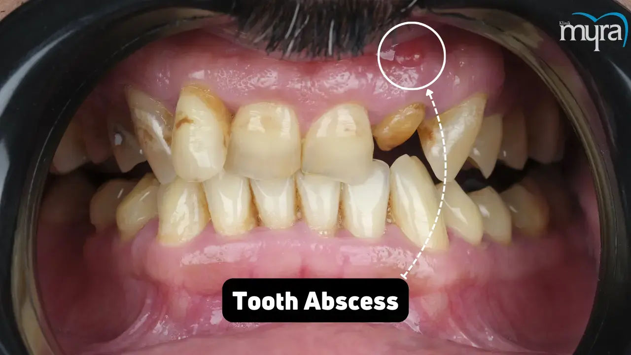 Tooth Abscess