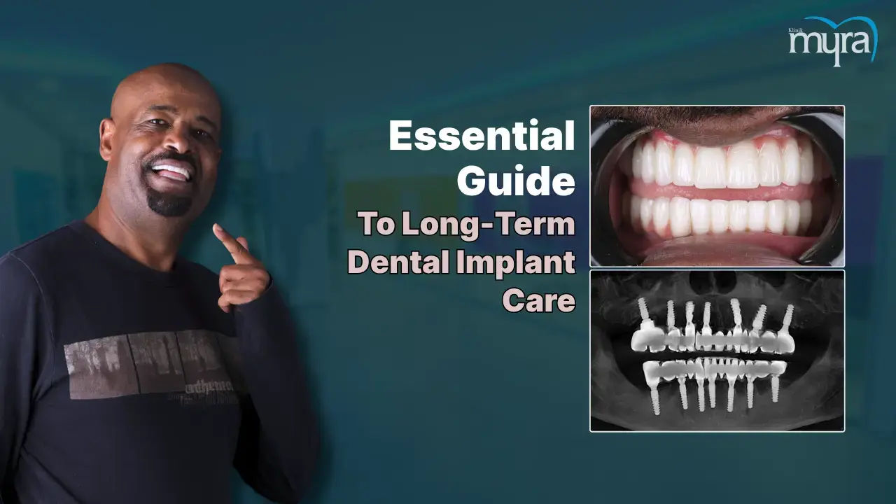 Care for Dental Implant