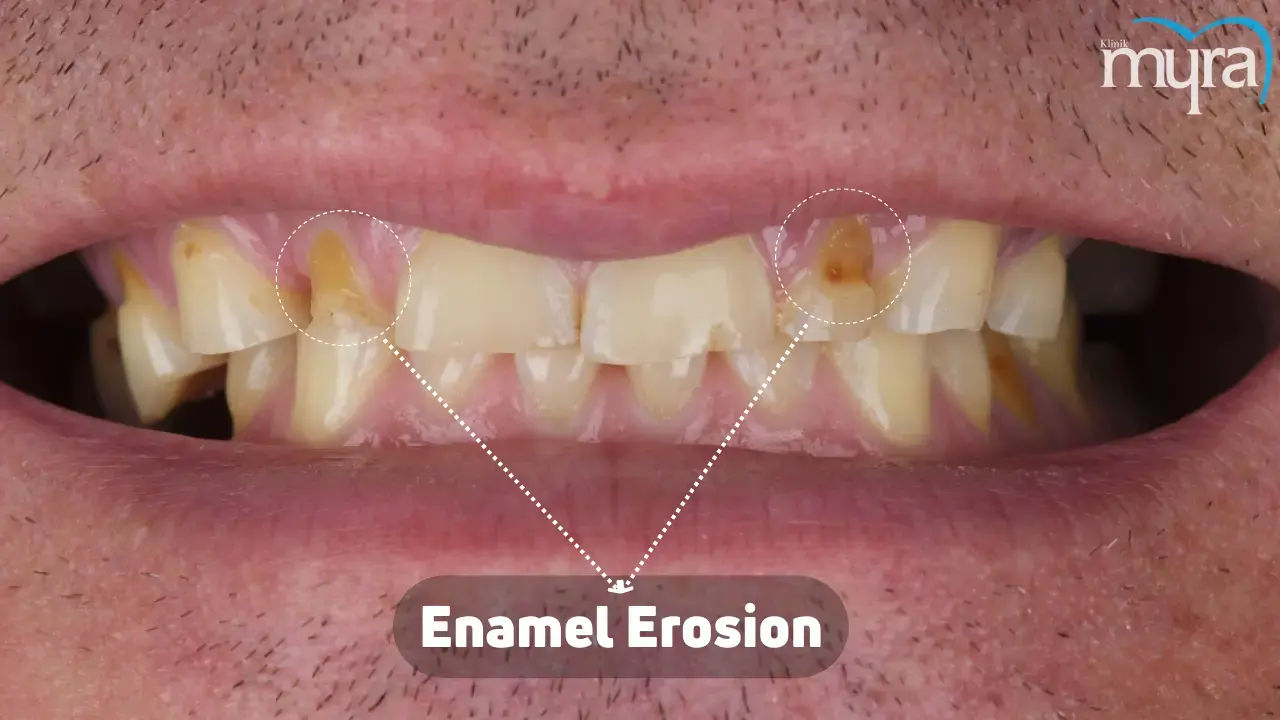 Enamel Erosion