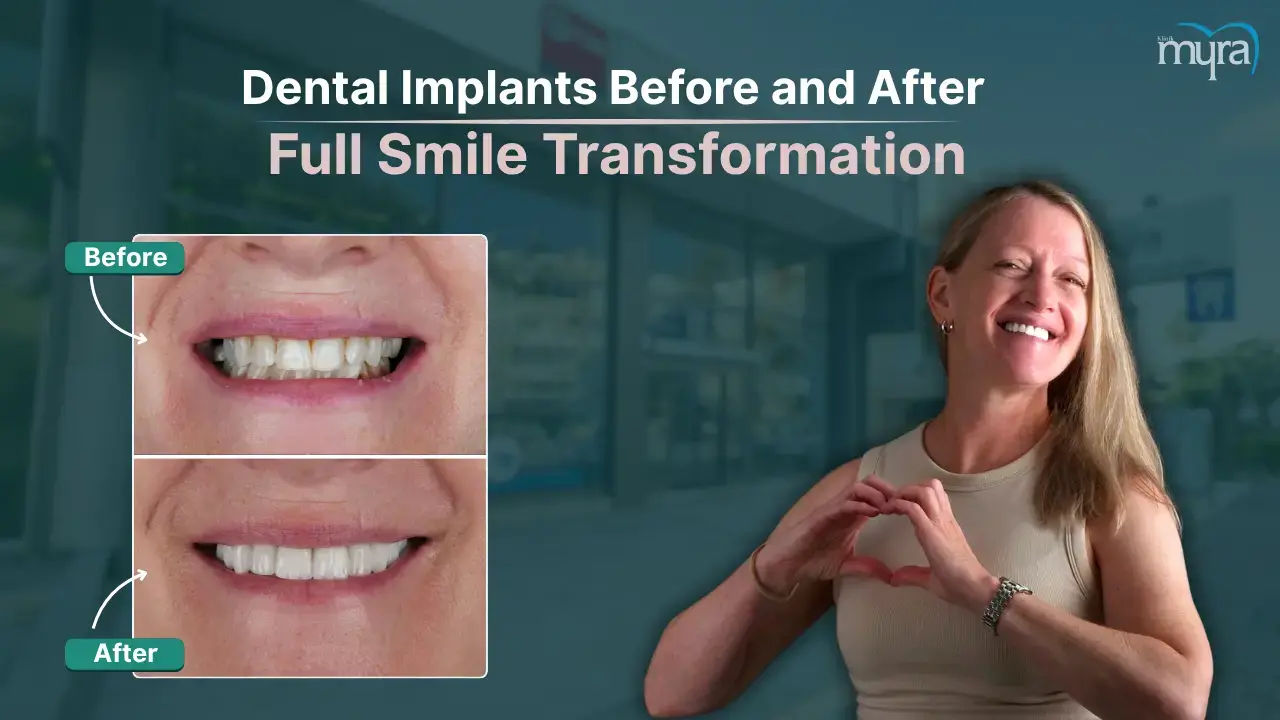 Dental İmplants Before After