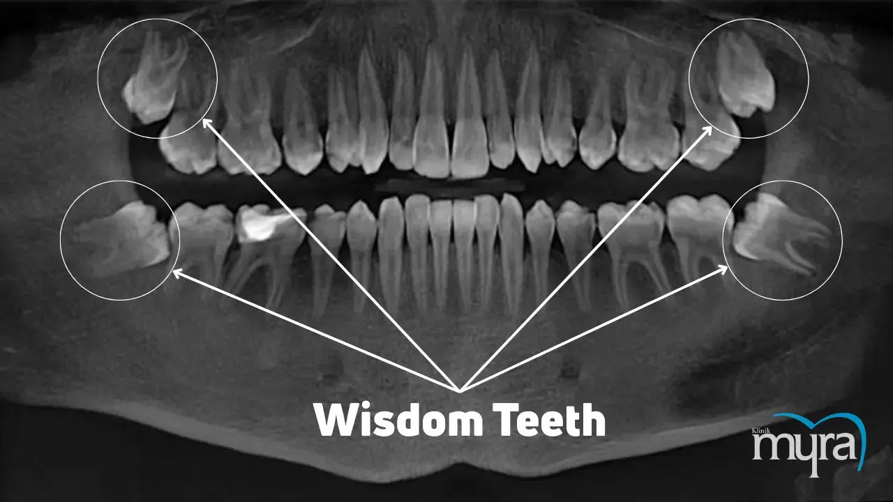 Wisdom-teeth