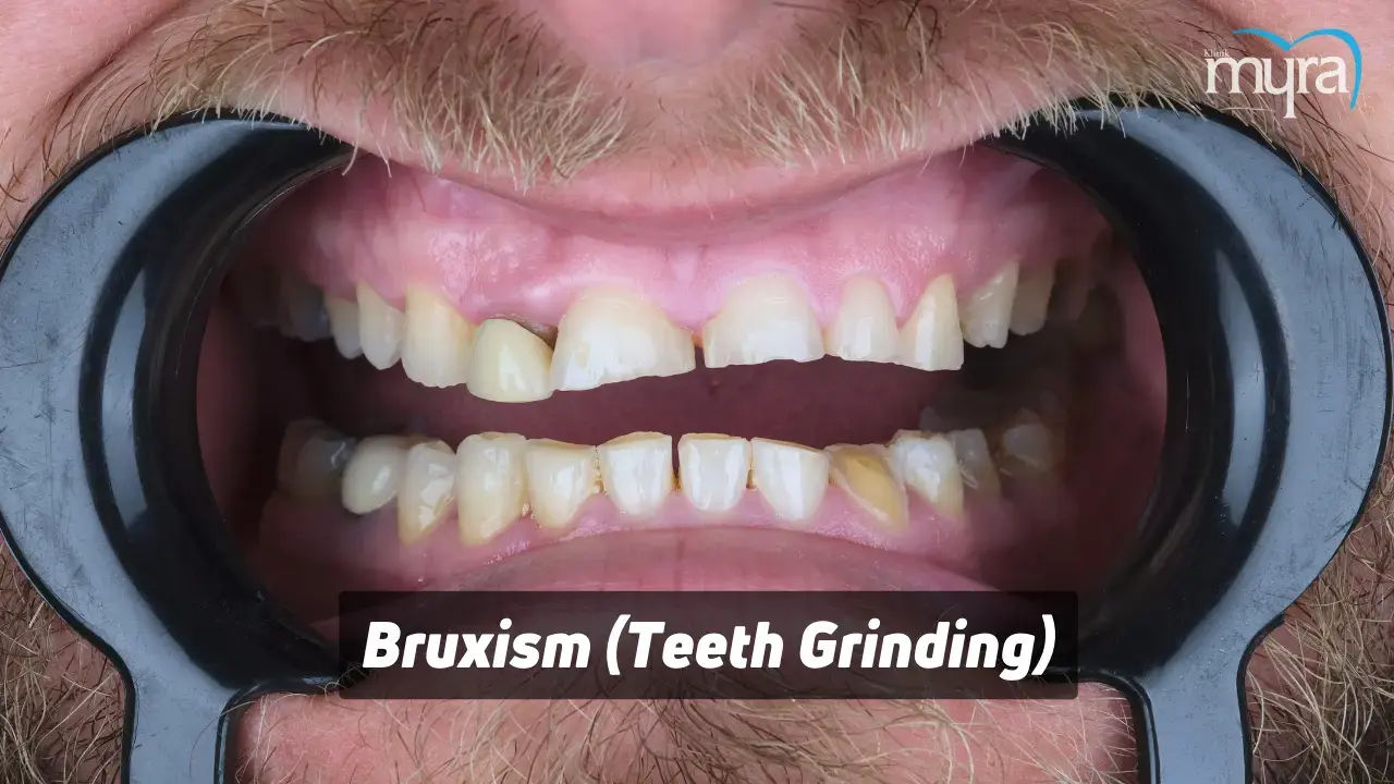 Bruxism-(teeth-Grinding)