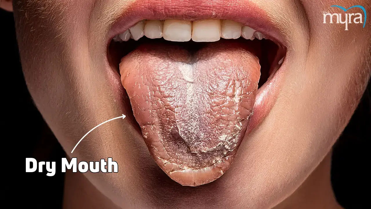 Dry Mouth