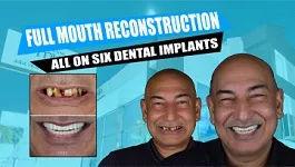 Full-mouth-reconstruction-all-on-seven-implants-with-porcelain-crowns