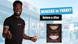 Full-set-of-veneers-turkey-grinded-uneven-teeth-zirconium