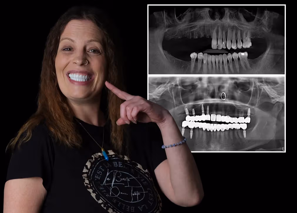 Cosmetic Dentures in Turkey: Definition, Importance, Types, Procedure and Advantages