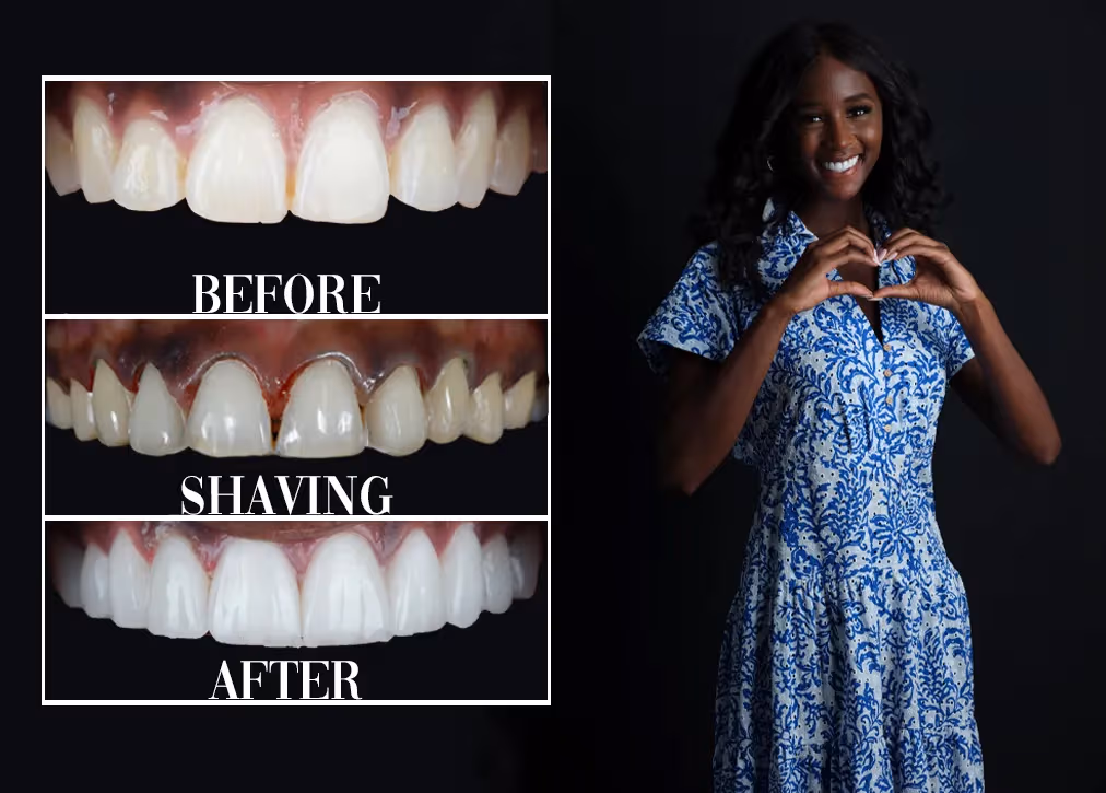 Laminate Veneers in Turkey Definition Importance Types Procedure and Advantages