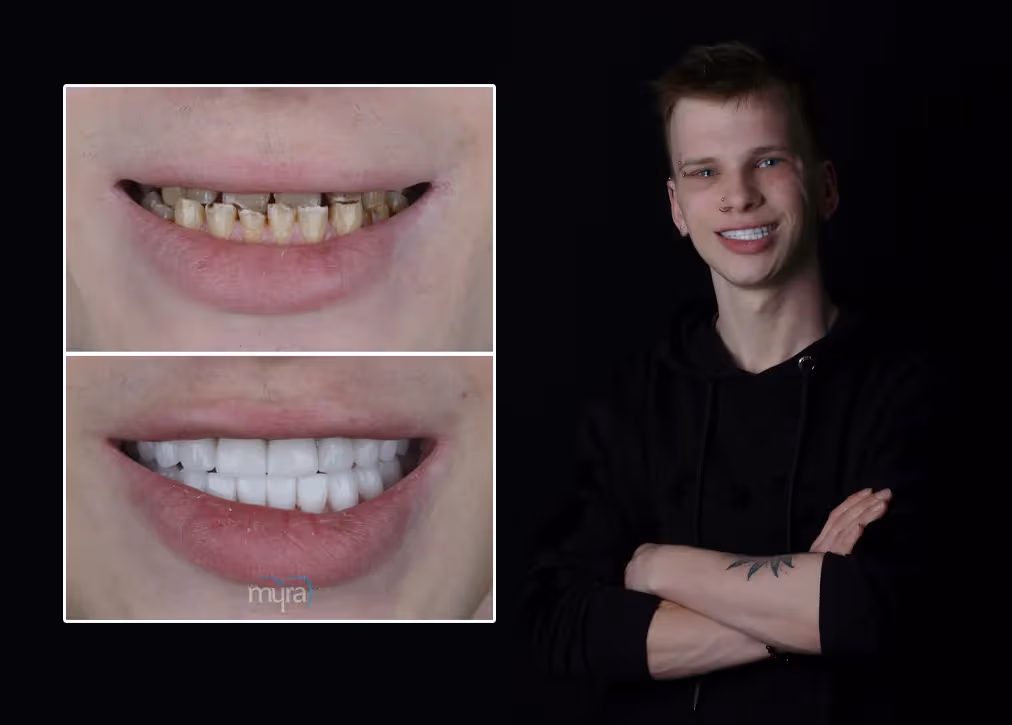 Zirconia Veneers Definition Importance Types Procedure and Advantages